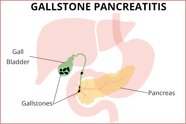 what causes gallstone pancreatitis?