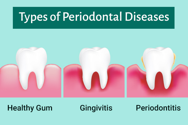 periodontal disease types