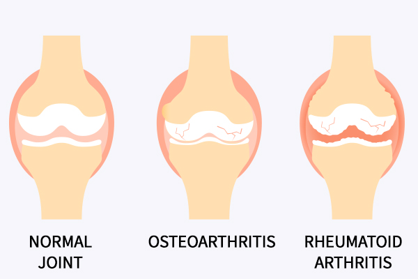 different types of hand arthritis