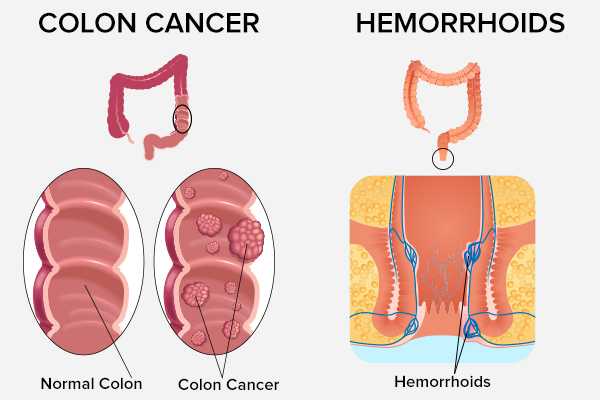 hemorrhoids versus colon cancer