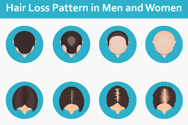 hair loss pattern in men and women