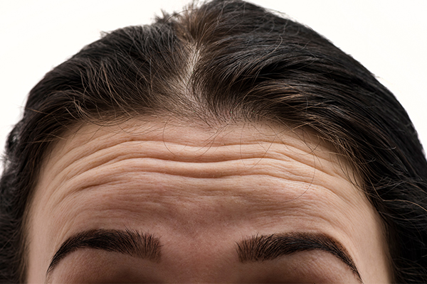 general queries about forehead wrinkles