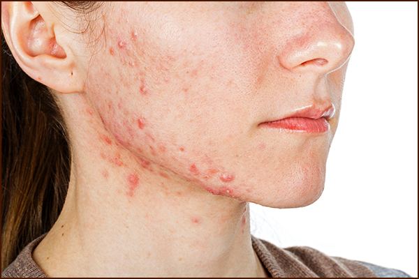 general queries about cystic acne