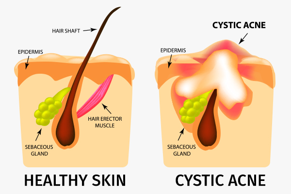 formation of cystic acne