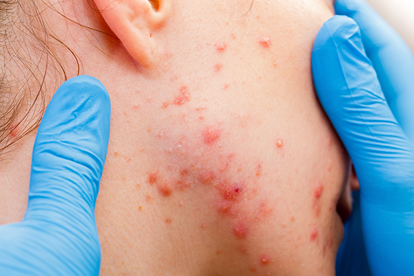 when to consult a doctor regarding cystic acne?
