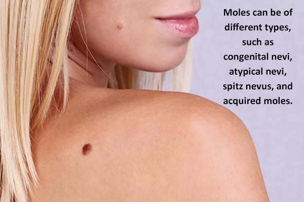 different types of moles