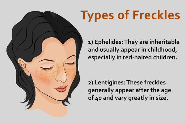 types of freckles