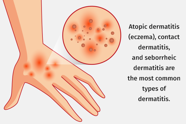 different types and causes of dermatitis