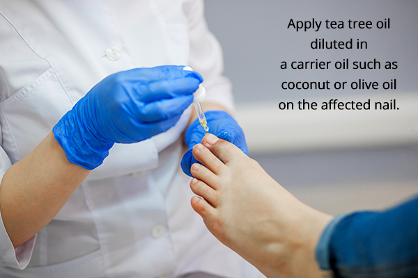 several topical antibiotics can help dry out ingrown toenails
