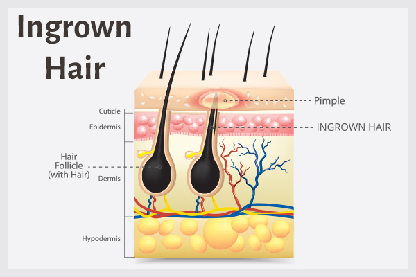 factors that can cause ingrown hair growth