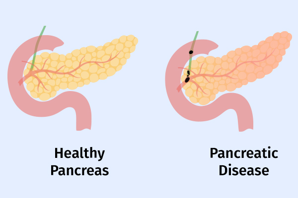 signs and symptoms of acute pancreatitis