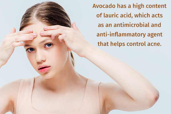 avocado can help manage and control acne
