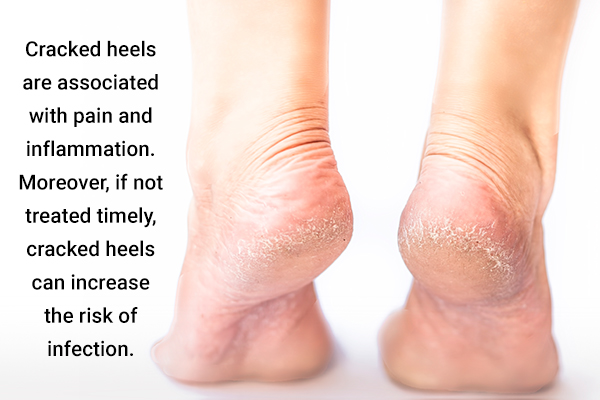 cracked heels can be treated with help of argan oil