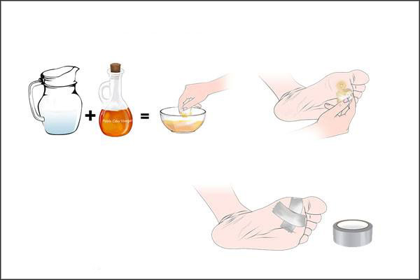 acv can be used to heal plantar warts