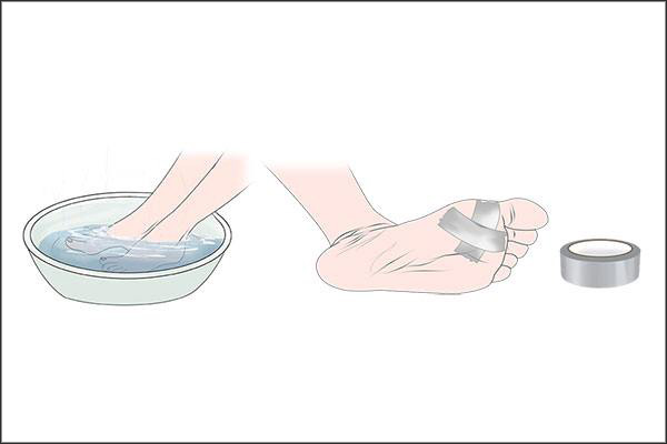 duct tape can be applied to soothe plantar warts