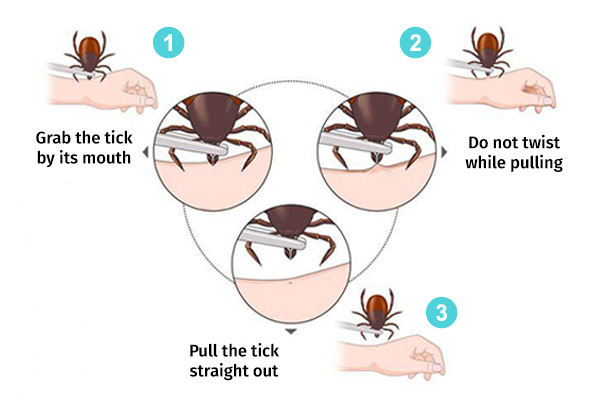 proper method of tick removal