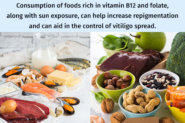 foods rich in vitamin b12 and folate can help manage vitiligo