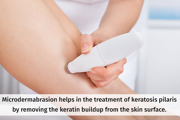 microdermabrasion can help treat keratosis pilaris