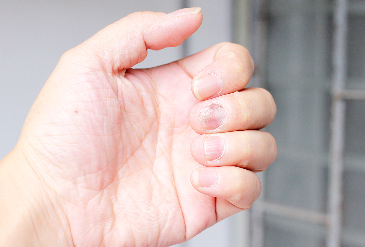 nail psoriasis causes