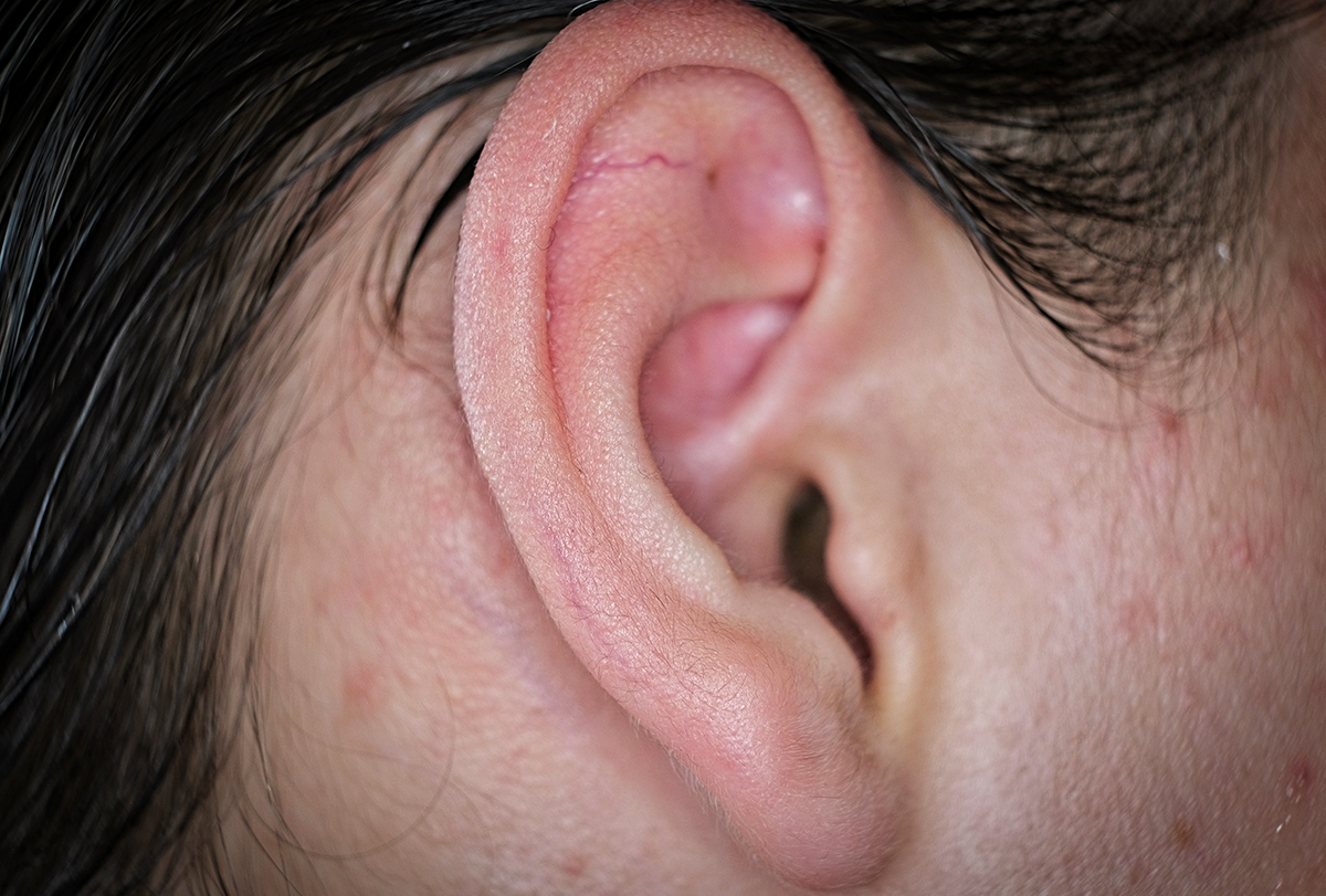 manage ear pimples