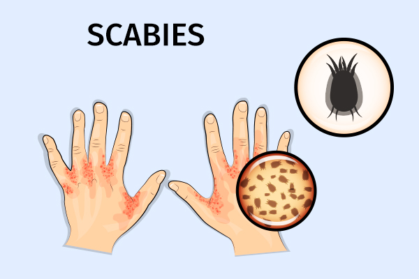 mode of transmission for scabies