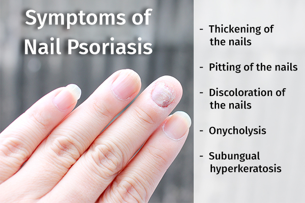 signs and symptoms of nail psoriasis