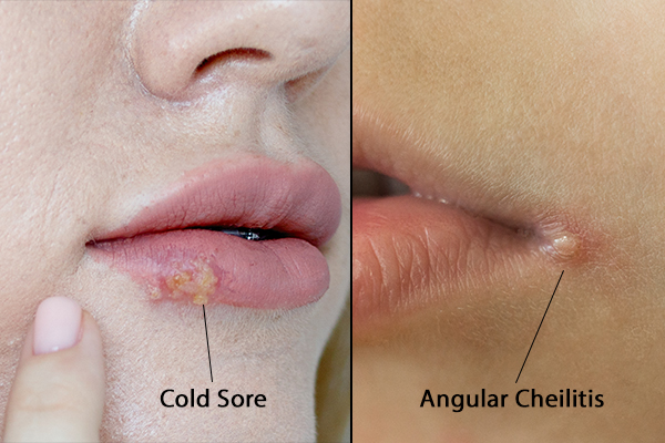 angular cheilitis v/s cold sores