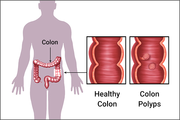 causes and risk factors that lead to colon polyps