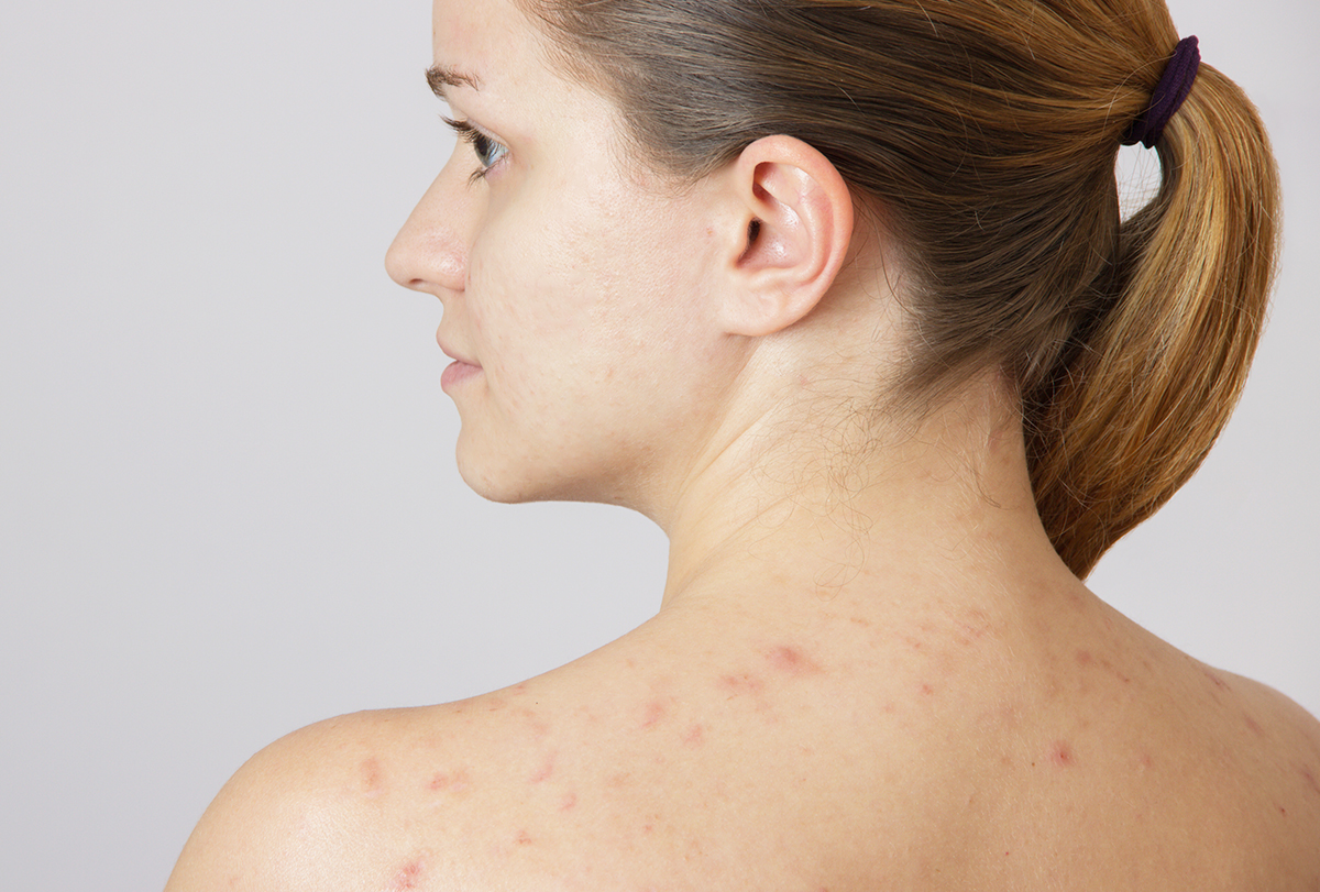 shoulder acne causes and treatment