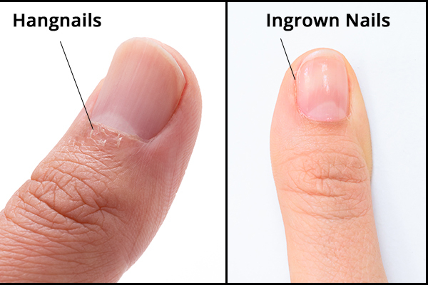 key differences b/w hangnails and ingrown nails