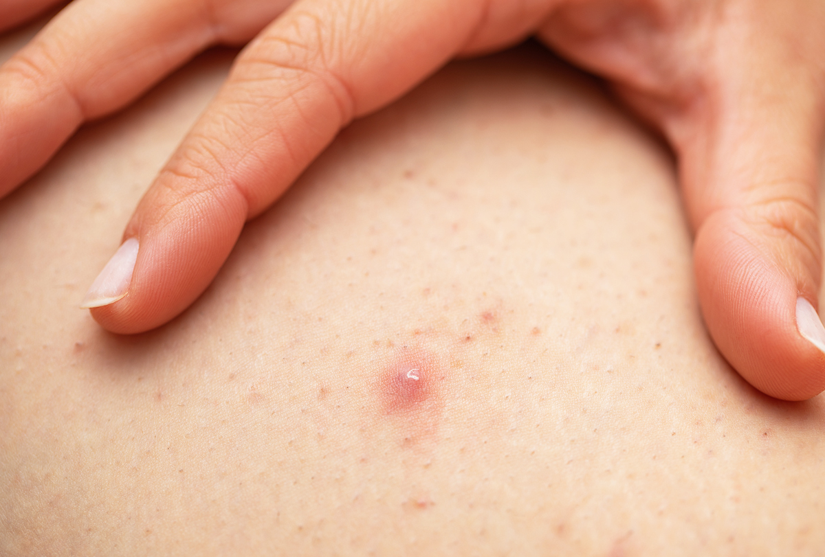 folliculitis: causes, signs, and treatment