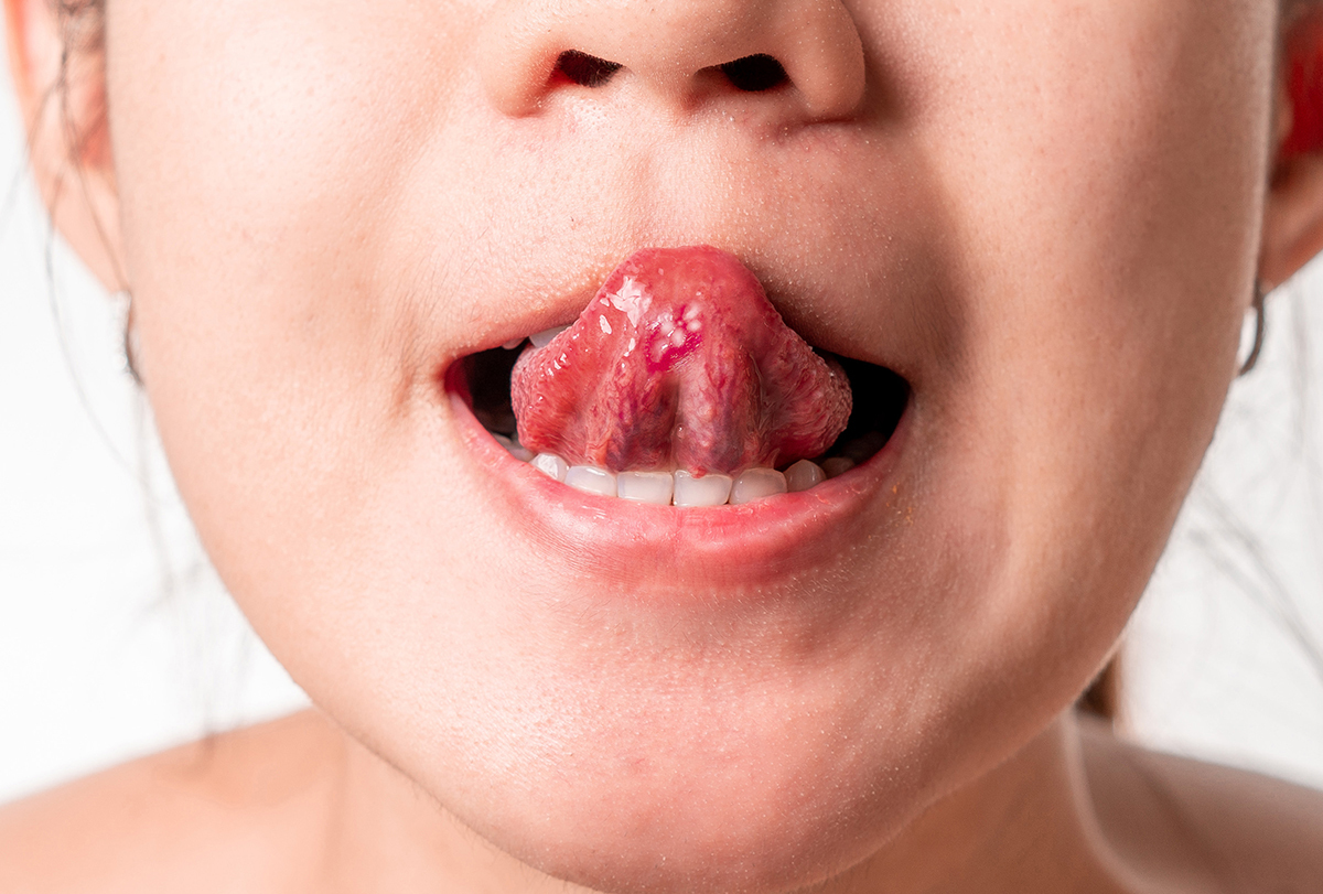 home remedies to help soothe tongue blisters