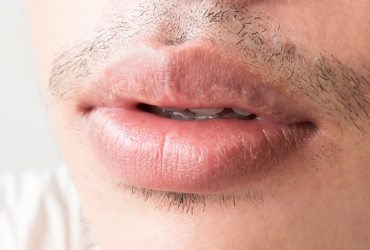 fordyce spots on lips: causes, signs, and treatment