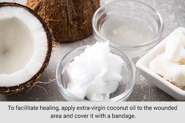 using coconut oil can help heal minor wounds