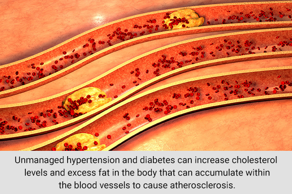 reducing cholesterol levels can decrease stroke risk