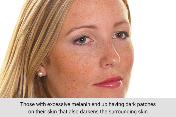 licorice usage can help prevent pigmentation