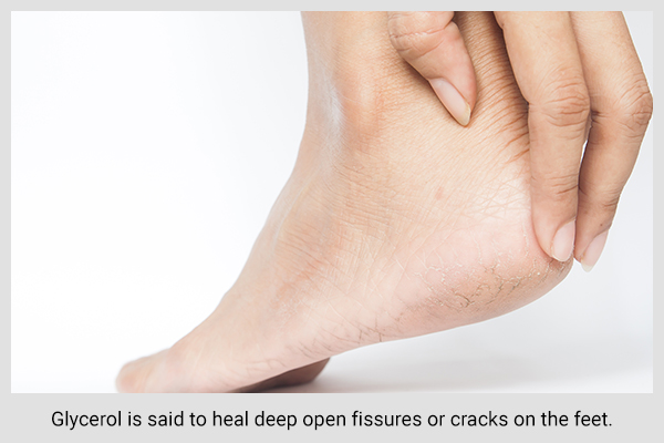 glycerol in glycerin can help heal cracks on the feet