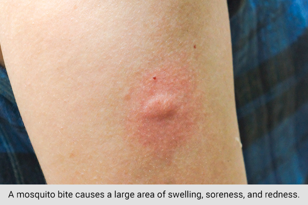 characteristic features of a mosquito bite
