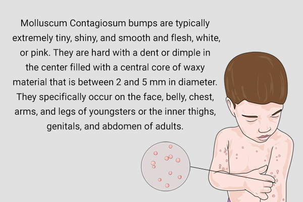 signs and symptoms indicative of molluscum contagiosum