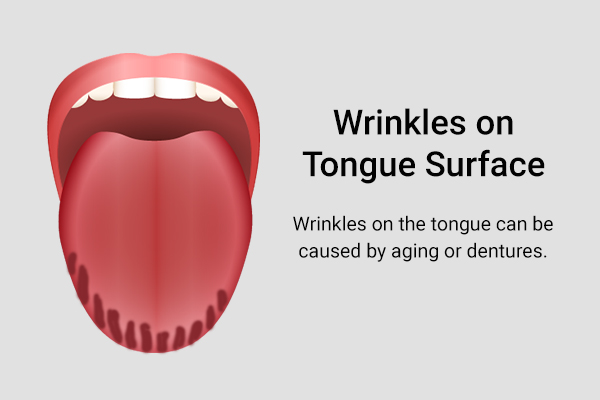 wrinkles on the tongue's surface can be caused by aging or using dentures