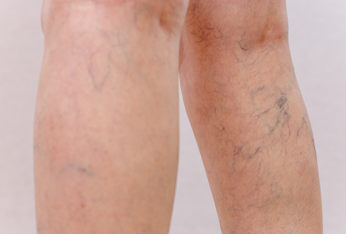 how to get rid of spider veins
