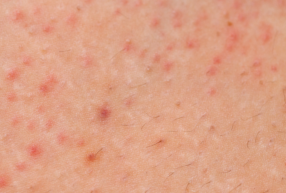 pimples on the knee: causes, management, and more