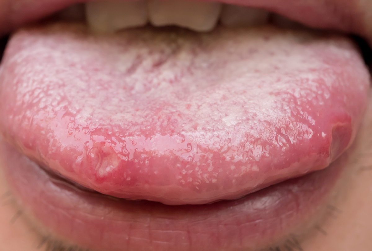 sore tongue: causes, signs, and diagnosis