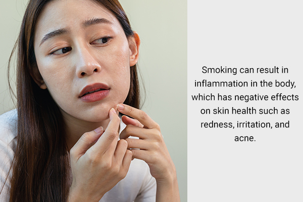 quitting smoking can help reduce inflammation and acne
