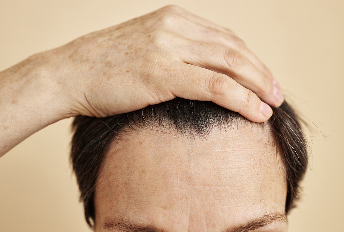 scalp biopsy for hair loss